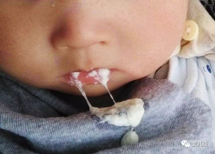                     “妈妈，我就吐个奶，咋就得上肺炎了？”宝宝吐奶时家长别做这件事…