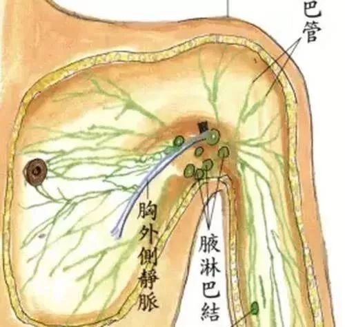 消灭副乳要这样做!_乳腺