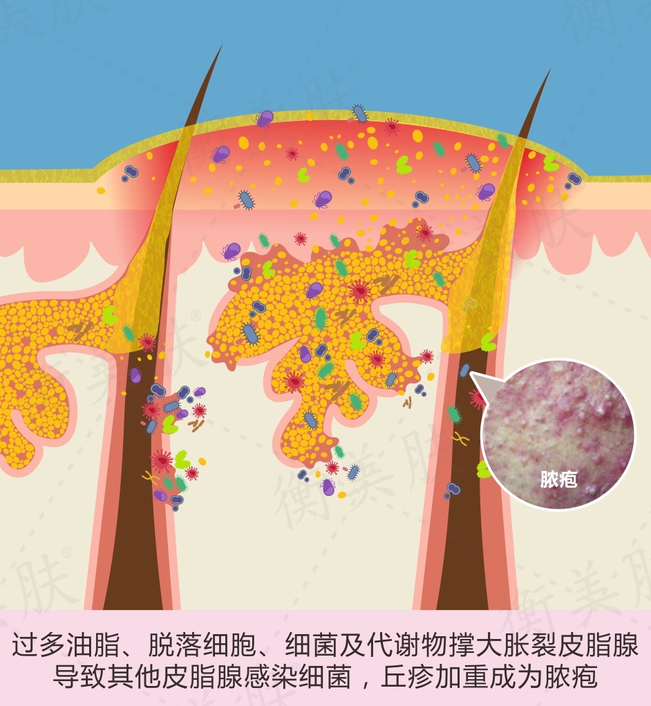 可以用在望打湿化妆棉轻轻擦拭红肿位置,避免细菌进一步感染