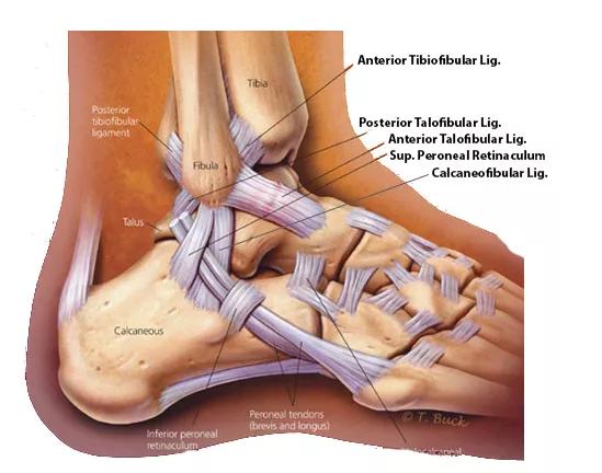 当崴脚内翻时,外侧副韧带会承受很大的被动拉伸力,这个拉伸力过大就会