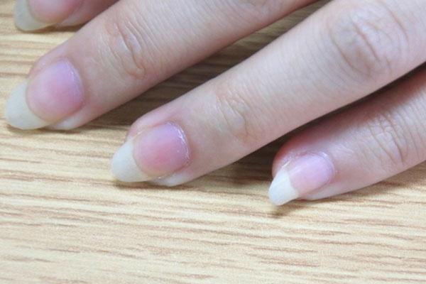                     指甲有竖纹怎么回事？保守估计：可能是这些情况引起的，需重视