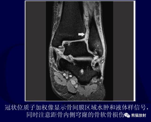 deltoidligament