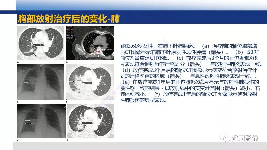 胸部放射治疗相关并发症影像诊断