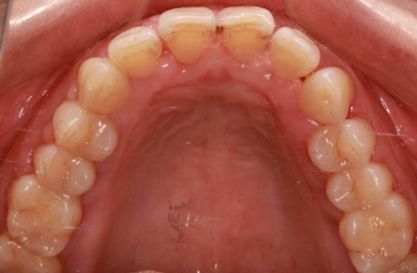 治疗前后上颌牙龈的变化