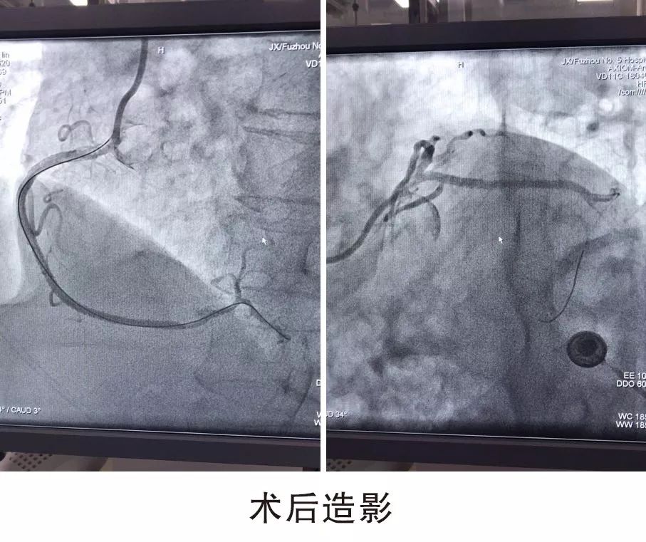 不到2小时就顺利完成右冠状动脉和回旋支的支架植入术,术后复查造影