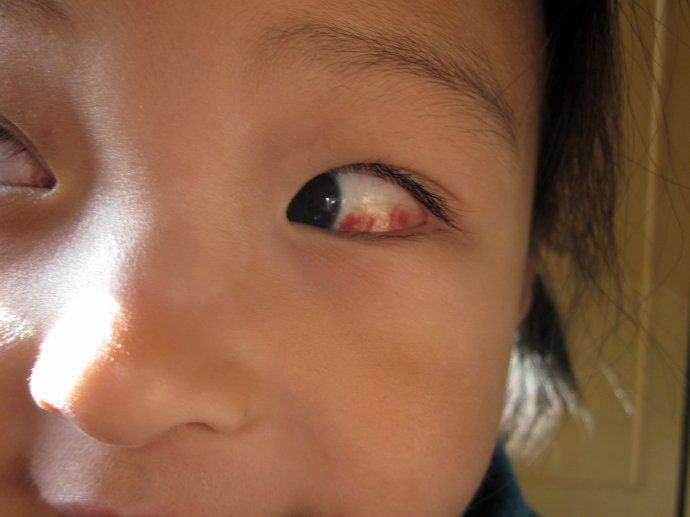 眼部充血明显,部分可发展为角膜结膜炎,眼痛,视物模糊等症状甚至可长