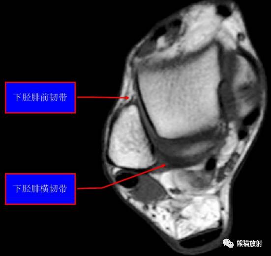 ct可以发现 x 片上不明显的骨折;而 mri 对诊断下胫腓联合韧带损伤