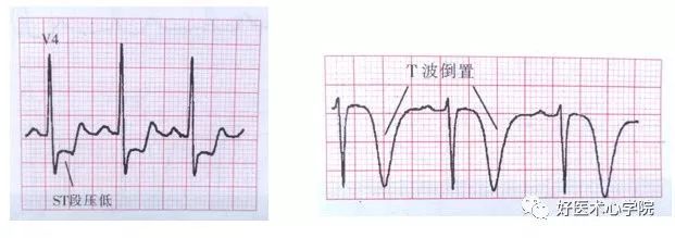 支气管炎胸痛怎么办