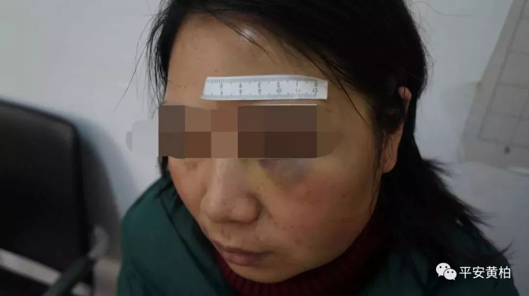 袁女士的损伤程度为轻伤一级,孙某的家暴行为已构成了刑事犯罪!