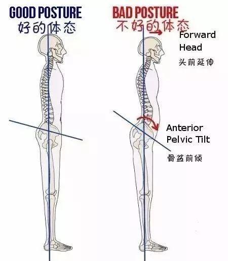 骨盆前倾,该怎么调整?