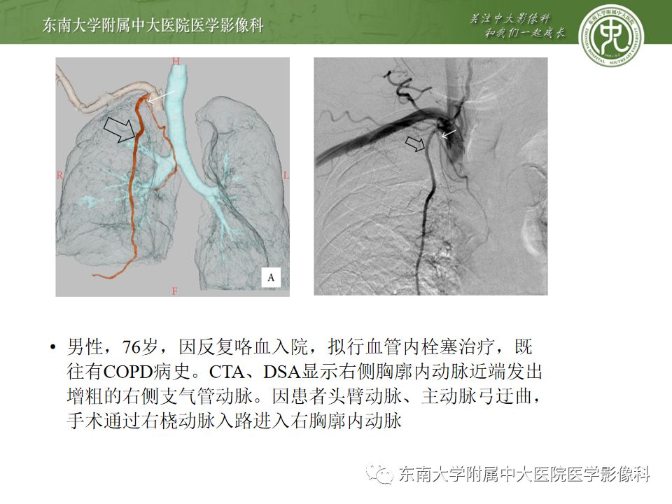 支气管动脉解剖及异常影像表现