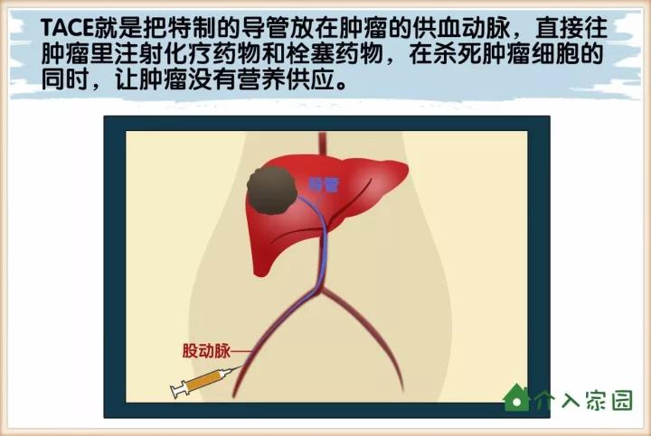 漫画科普介入│肝癌最常用的治疗方案,为什么是它?