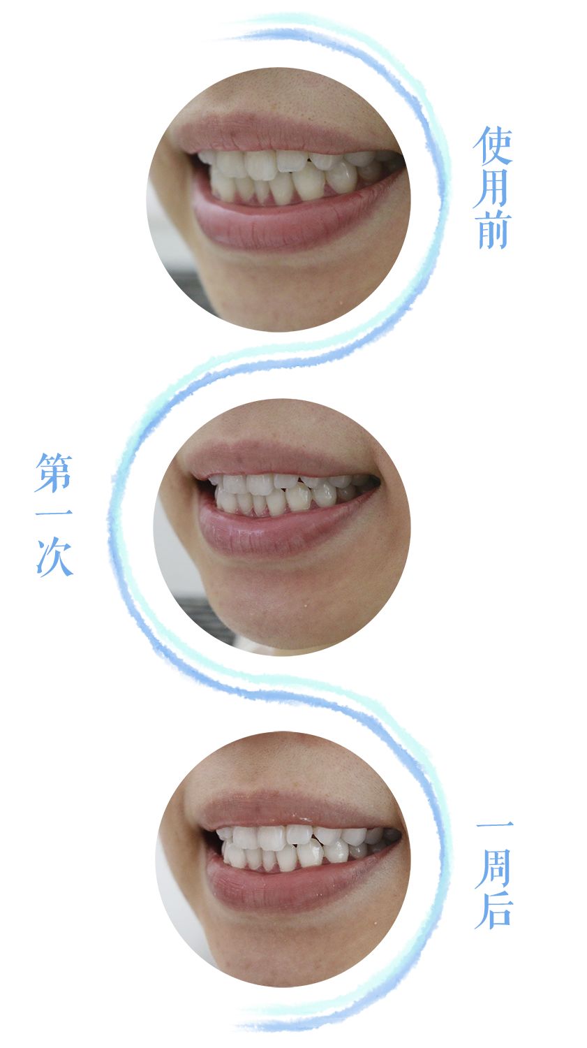 上镜怎能牙黄?我是怎么美白牙齿的