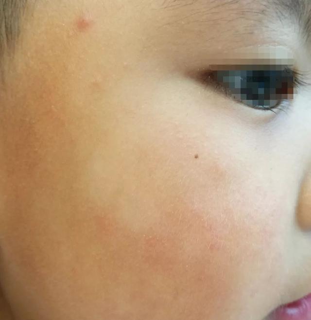 "医生,我家小孩已经打过几次虫了,脸上的虫斑还是没有退.