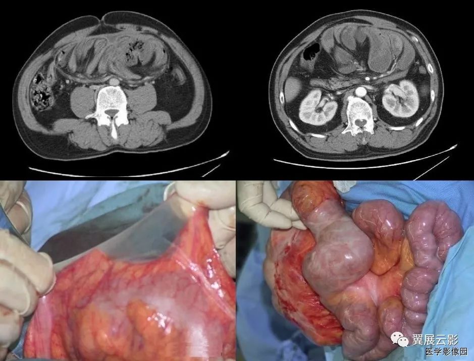 26种腹部消化系统重要影像征象助您轻松掌握腹部疾病