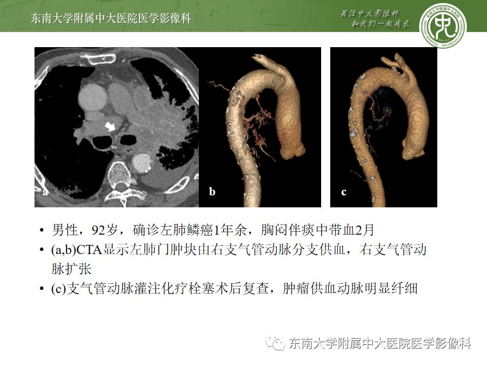 支气管动脉解剖及异常影像表现