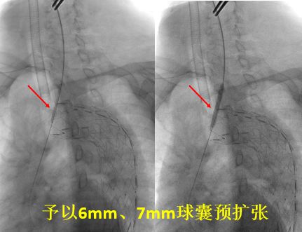 胸主动脉夹层(tevr)术后支架源性分支血管闭塞的ii期处理——(腔内篇)