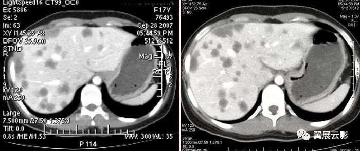 26种腹部消化系统重要影像征象助您轻松掌握腹部疾病