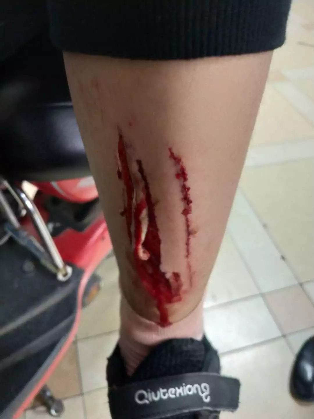 女孩误磕铁柱遭"割皮" 家长维权被"踢皮球"