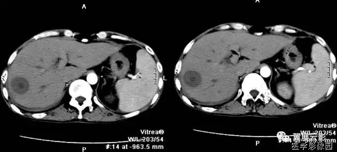 26种腹部消化系统重要影像征象助您轻松掌握腹部疾病