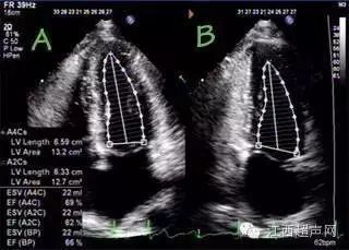 心脏超声测量的规范标准