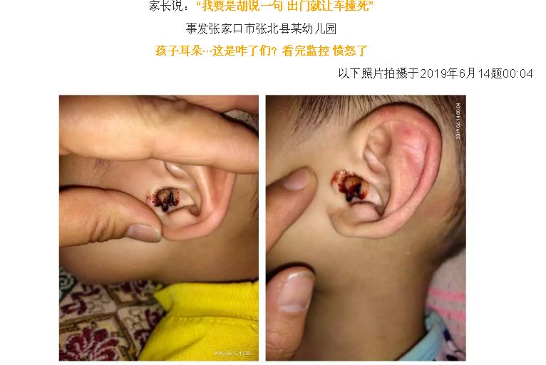 辟谣,网传张北一幼儿园孩子耳朵被老师打出血!教育局