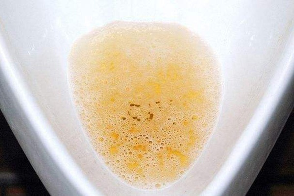 男性晨起的第一泡尿,若四种情况,一种都不占,说明肾脏