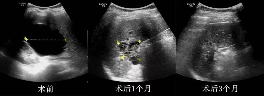 新绛关注囊肿的治疗可以这么简单