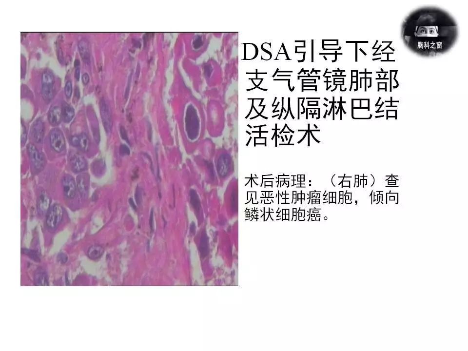 一例同时合并结核的肺鳞状细胞癌