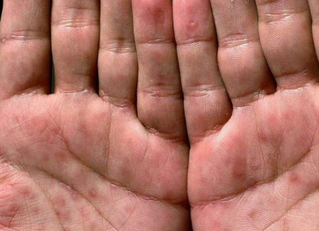 梅毒人口占比_60岁以上人口占比图