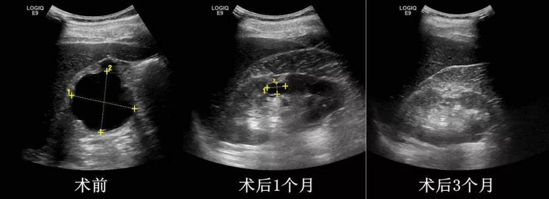 新绛关注囊肿的治疗可以这么简单