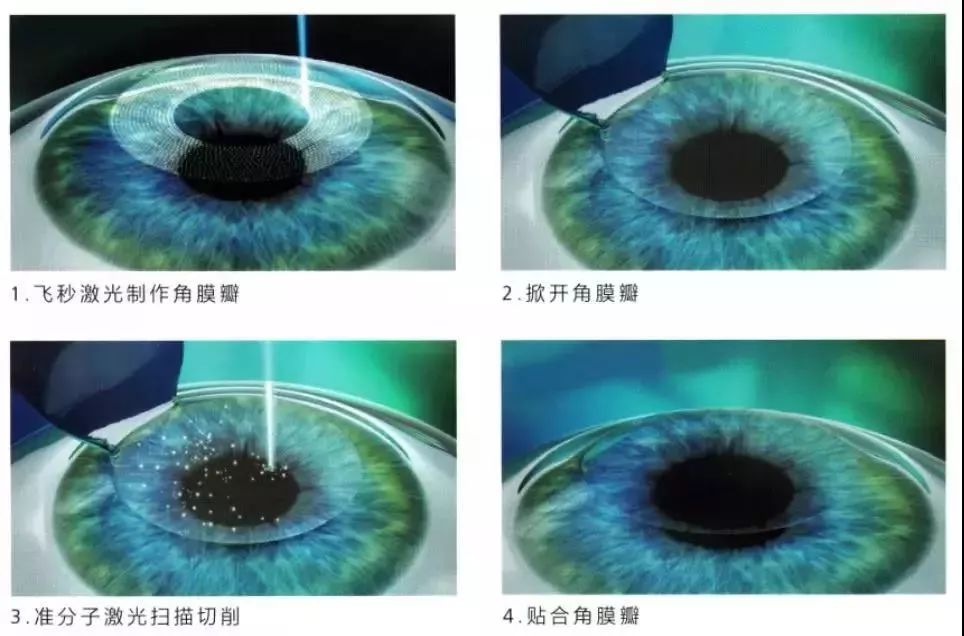 激光近视手术原理详解 1658f8c50a8f4b35b9c0999dcb149aa5.jpeg