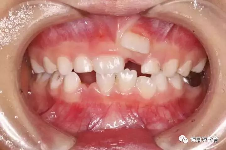 10个孩子里5个长双排牙,医生感叹:都是家长喂出来的