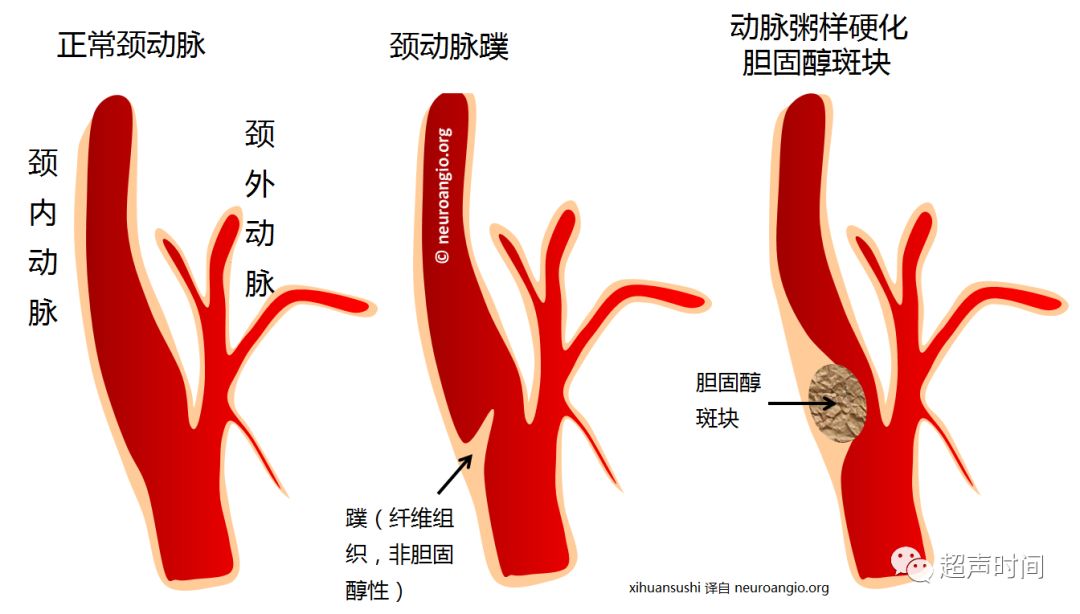 超声典型病例颈动脉蹼carotidweb