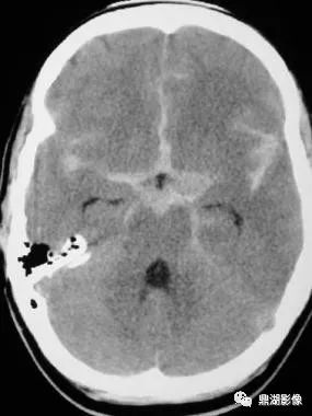 中级病例 | 蛛网膜下腔出血影像表现