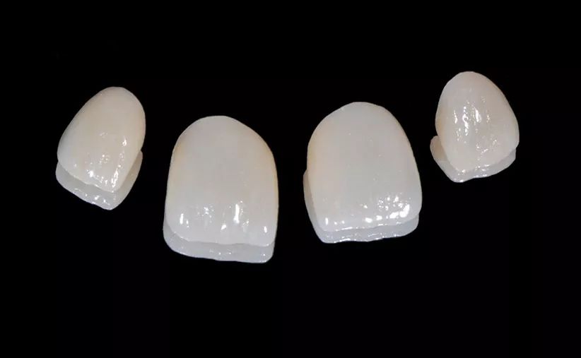 最近的研究有 · 使用瓷贴面修复上颌前牙效果如何?