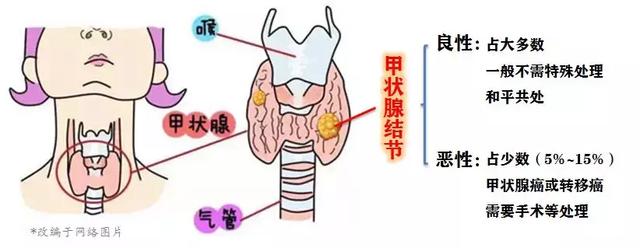 甲状腺结节是怎么回事呢？
