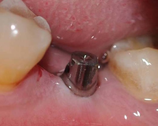 牙周炎牙龈萎缩,掉牙厉害可以种植牙吗?