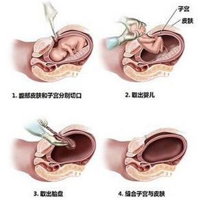 难产,还会导致孕妈们体态臃肿,行动不便,同时腹壁脂肪层过厚,胎儿过大