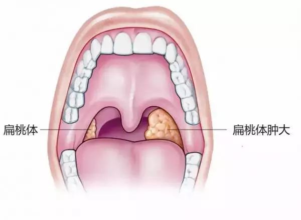 大人口腔37度算发烧吗_口腔上颚疼痛还发烧(3)