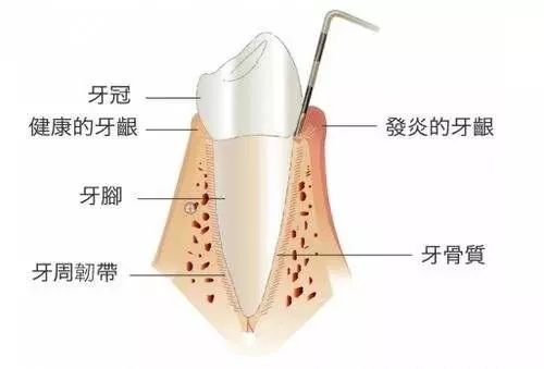 牙痒痒怎么办