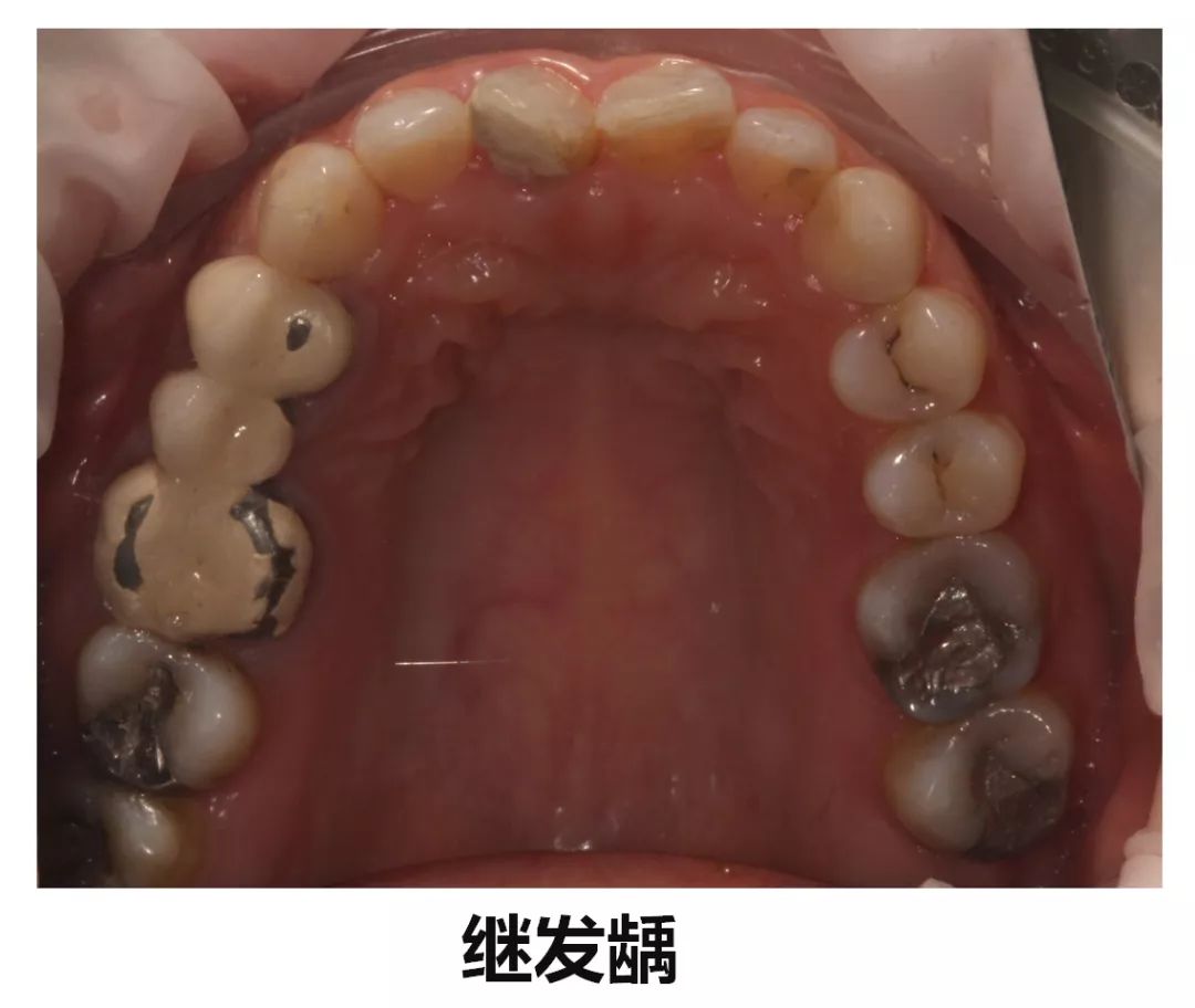 注意!牙齿上的"小黑点"竟然这么可怕,千万别忽视