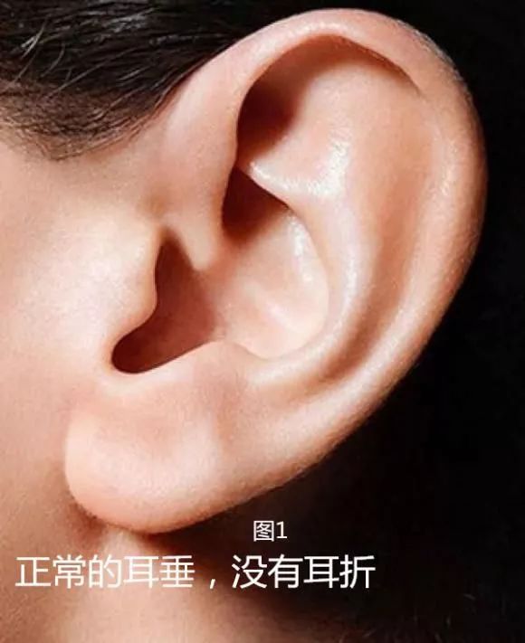 耳垂有折痕是什么原因照片 355e35a174fc4146ad82033e544ad52c.jpeg