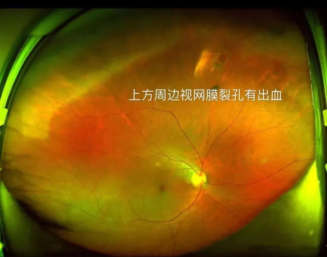 撞击或体位突然改变(常见于健身))的情况下牵拉视网膜产生视网膜裂孔