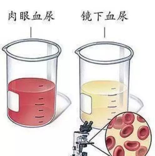 引起"血尿"的食物药物有哪些?