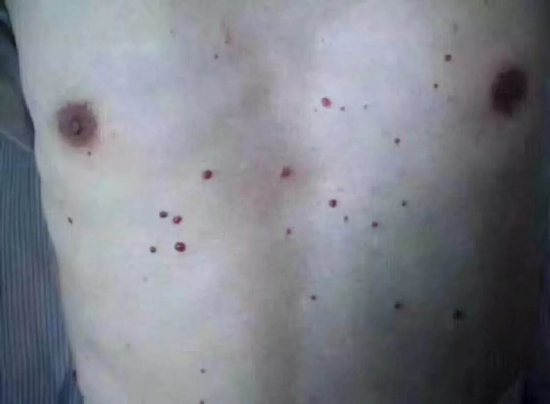 什么是黑色素瘤恶性的 4382ae4ebac6409ca2841e7ab4cb3878.jpeg