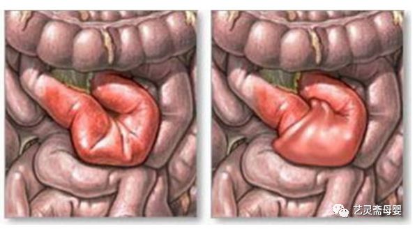 "夺命"肠套叠,月嫂,宝妈辨别,预防有方法!