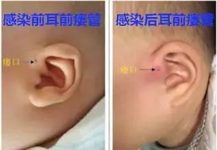                     用棉签给1岁女儿掏耳，却把她鼓膜穿破：这2种方法才能清理耳朵