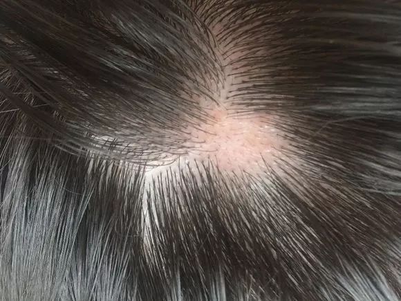 01 斑秃 02  头癣 03 由 真菌感染头皮及毛发损伤毛干所致,多见于3~7