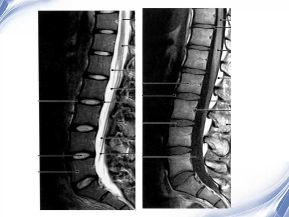 腰椎退行性变腰痛的mr诊断 | 影像天地